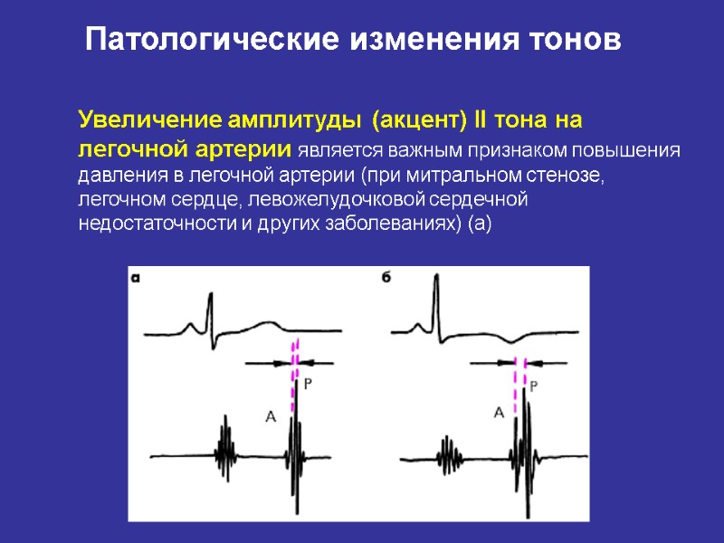 Патологические изменения тонов Увеличение амплитуды (акцент) II тона на легочной артерии является важным признаком